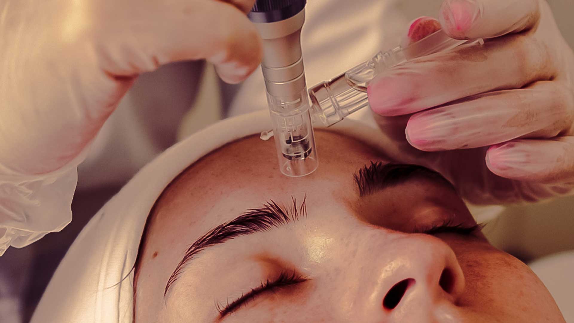 los angeles microneedling